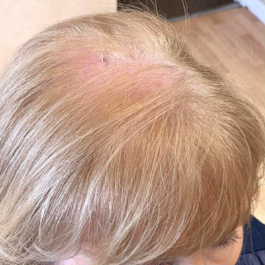 scarring from medical procedure scar scarring from medical procedure scar