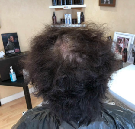 black thinning scalp 2