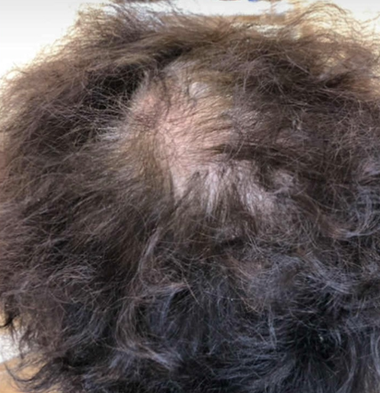 black thinning scalp
